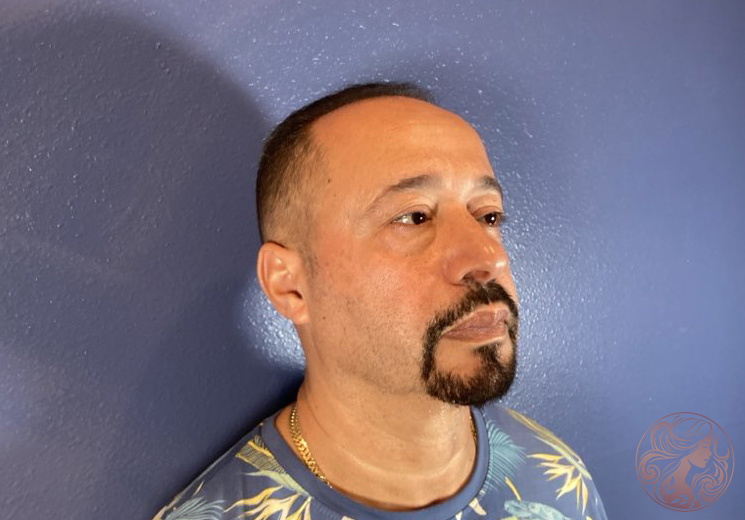 Upper and lower blepharoplasty, before treatment, front view showing eyelid heaviness and under-eye puffiness. Viradia Plastic Surgery.