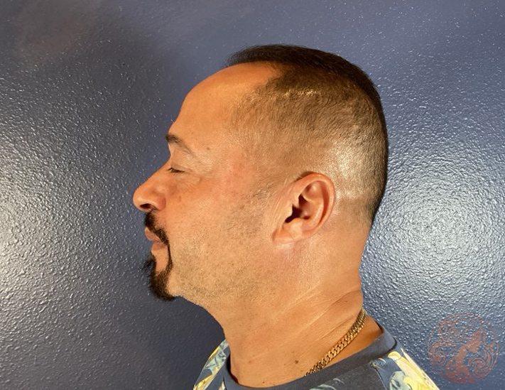 Upper and lower blepharoplasty, before treatment, side view showing eyelid sagging and under-eye fullness. Viradia Plastic Surgery.