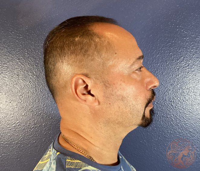 Upper and lower blepharoplasty, before treatment, angled view showing eyelid heaviness and under-eye bags. Viradia Plastic Surgery.