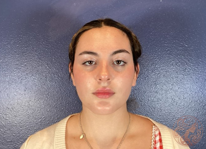 Otoplasty ear pinning, after treatment, front view showing ears repositioned closer to the head with improved symmetry. Viradia Plastic Surgery.