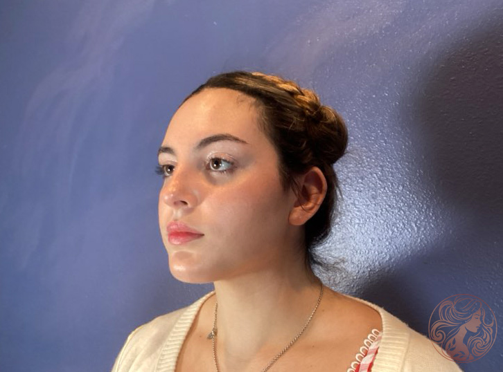 Otoplasty ear pinning, after treatment, angled view showing ears repositioned closer to the head with natural contour. Viradia Plastic Surgery.