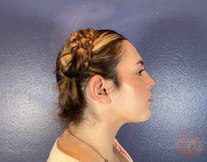 Otoplasty ear pinning, after treatment, side view showing improved ear positioning closer to the head. Viradia Plastic Surgery.