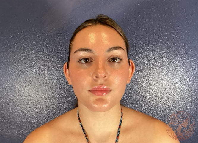 Otoplasty ear pinning, before treatment, front view showing prominent ears projecting outward. Viradia Plastic Surgery.