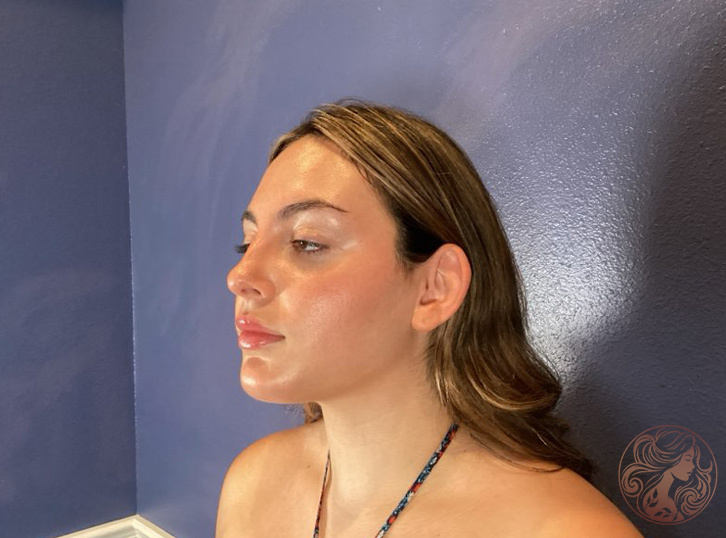 Otoplasty ear pinning, before treatment, angled view showing ears protruding from the head. Viradia Plastic Surgery.