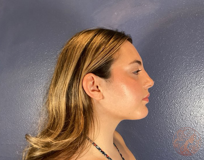 Otoplasty ear pinning, before treatment, side view showing ear projection from the head. Viradia Plastic Surgery.