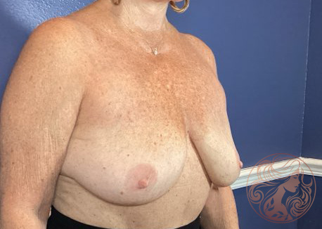 Breast lift with fat grafting, before treatment, oblique view showing breast sagging and loss of upper fullness. Viradia Plastic Surgery.