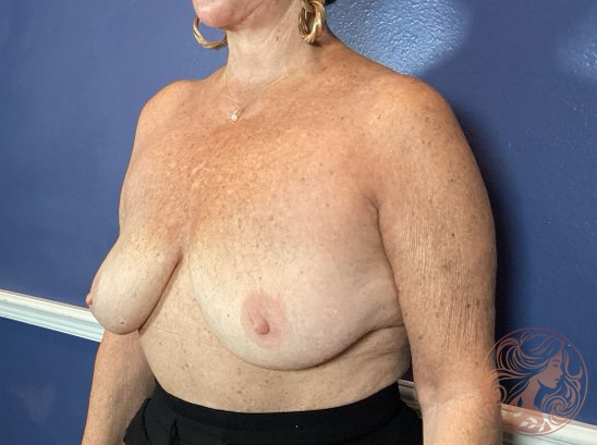 Breast lift with fat grafting, before treatment, side view showing breast ptosis and decreased projection. Viradia Plastic Surgery.
