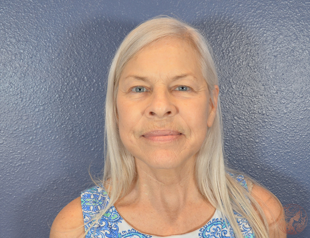 Deep plane facelift with neck lift and facial fat grafting, after treatment, front view showing a refined jawline, smoother contours, and a more youthful, natural appearance. Viradia Plastic Surgery.