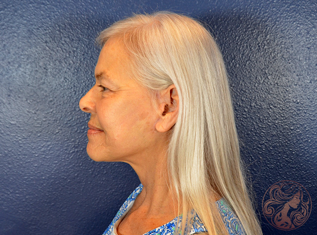 Deep plane facelift with neck lift and facial fat grafting, after treatment, angled view showing improved jawline definition and smoother facial contours. Viradia Plastic Surgery.