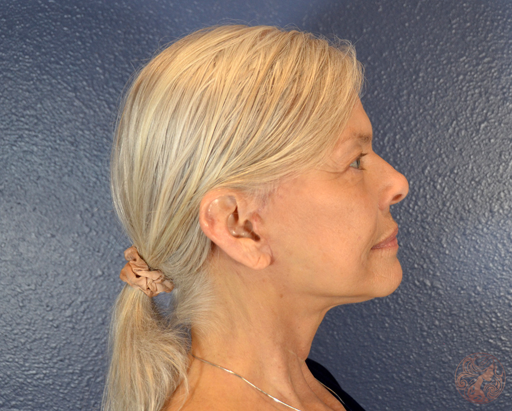 Deep plane facelift with neck lift and facial fat grafting, after treatment, side view showing a more defined jawline and improved neck contour. Viradia Plastic Surgery.