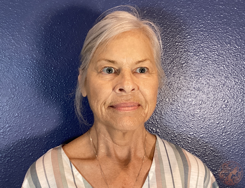 Deep plane facelift with neck lift and facial fat grafting, before treatment, front view showing facial sagging, deep folds, and reduced jawline definition. Viradia Plastic Surgery.