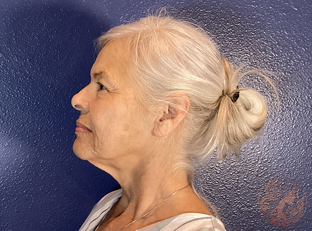 Deep plane facelift with neck lift and facial fat grafting, before treatment, angled view showing facial laxity and loss of contour along the jawline and neck. Viradia Plastic Surgery.