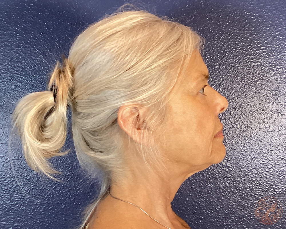 Deep plane facelift with neck lift and facial fat grafting, before treatment, side view showing sagging along the jawline and neck. Viradia Plastic Surgery.