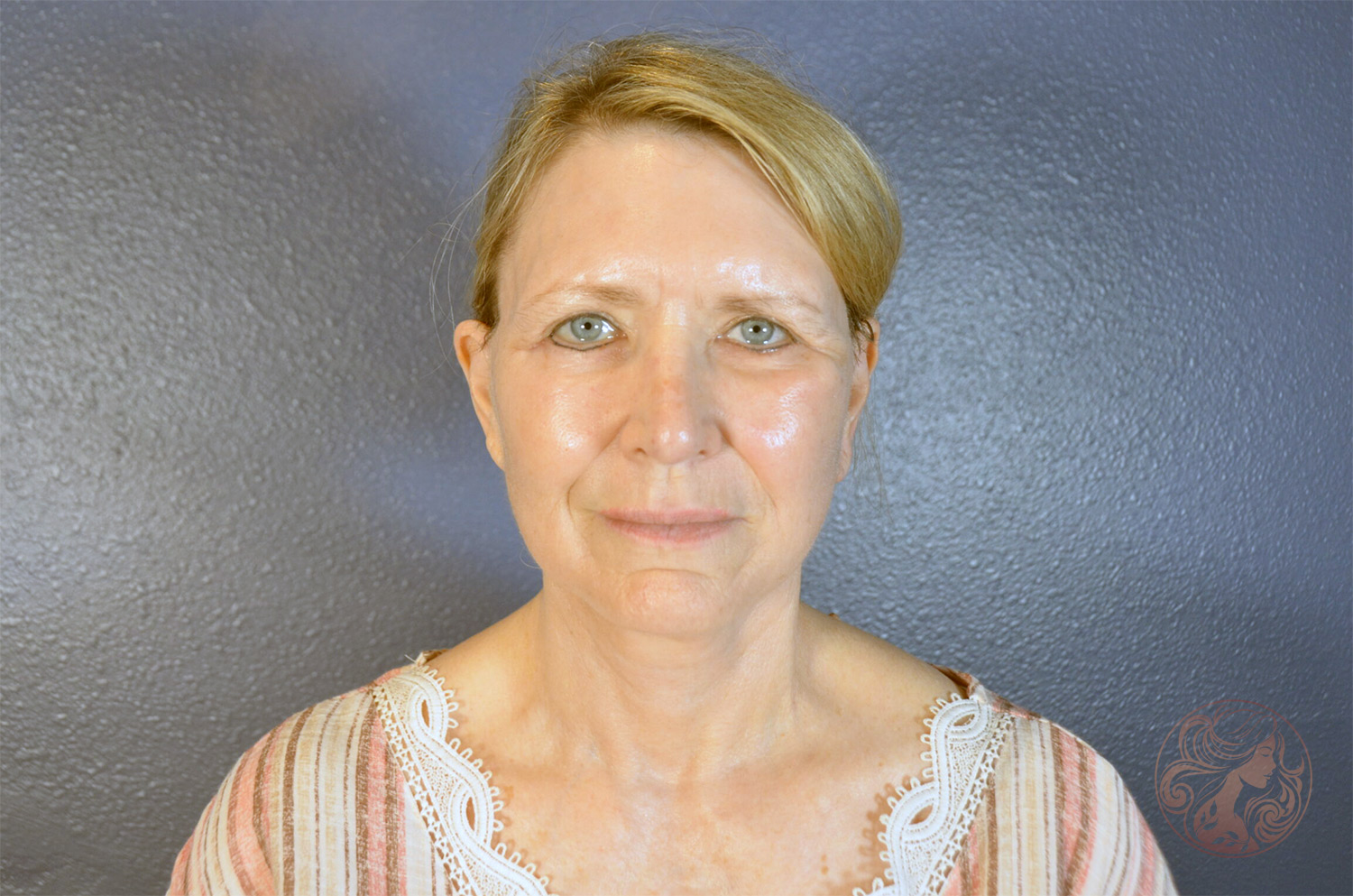 Deep plane facelift with neck lift, brow lift, lower blepharoplasty, facial fat grafting, and CO2 laser resurfacing, after treatment, front view showing a smoother jawline, refreshed eyes, restored facial volume, and brighter skin. Viradia Plastic Surgery.