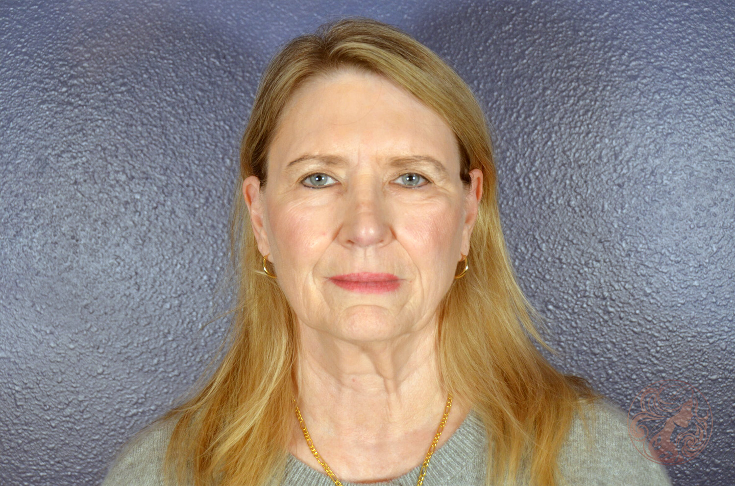 Deep plane facelift with neck lift, brow lift, lower blepharoplasty, facial fat grafting, and CO2 laser resurfacing, before treatment, front view showing facial laxity, brow descent, under-eye puffiness, cheek volume loss, and uneven skin texture. Viradia Plastic Surgery.