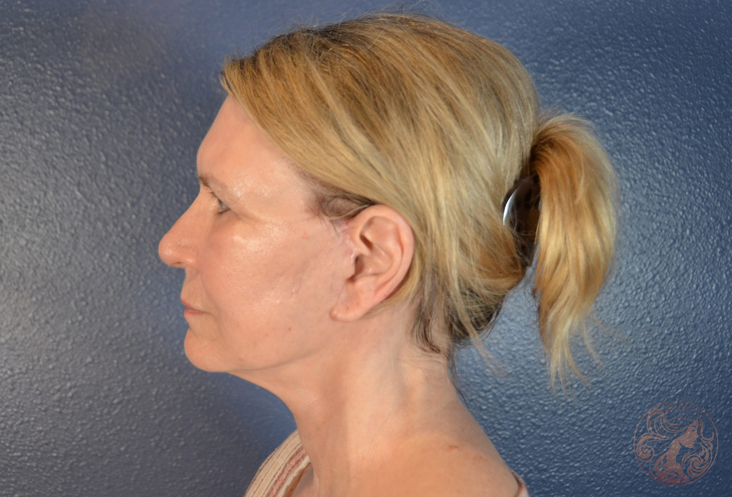 Deep plane facelift with neck lift, brow lift, lower blepharoplasty, facial fat grafting, and CO2 laser resurfacing, after treatment, side view showing improved jawline definition, smoother neck contour, refreshed eyes, and restored facial balance. Viradia Plastic Surgery.