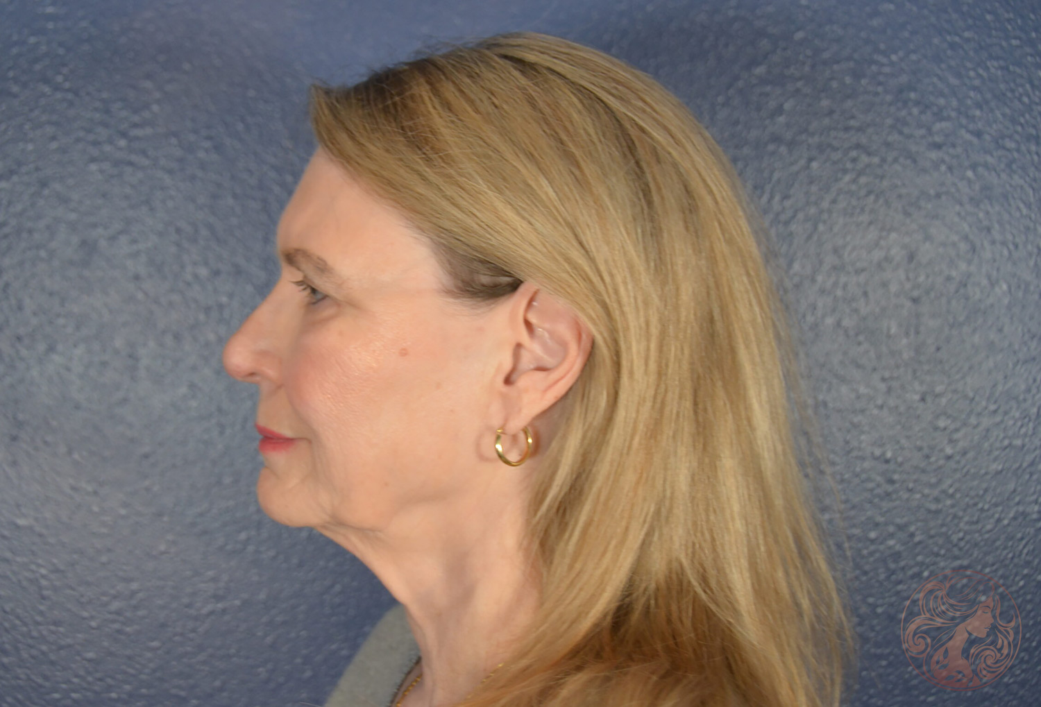 Deep plane facelift with neck lift, brow lift, lower blepharoplasty, facial fat grafting, and CO2 laser resurfacing, before treatment, side view showing neck laxity, jawline softening, brow descent, and cheek volume loss. Viradia Plastic Surgery.
