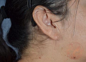 After photo of earlobe repair patient, side view, at Viradia Plastic Surgery in Tampa Bay, FL.