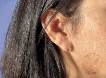 Before photo of earlobe repair patient, side view, at Viradia Plastic Surgery in Tampa Bay, FL.