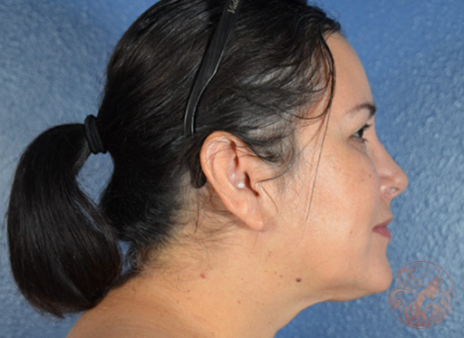 After photo of neck liposuction patient, side view, at Viradia Plastic Surgery in Tampa Bay, FL.