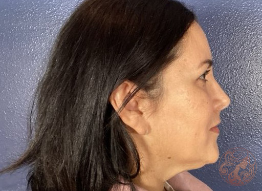 Before photo of neck liposuction patient, side view, at Viradia Plastic Surgery in Tampa Bay, FL.